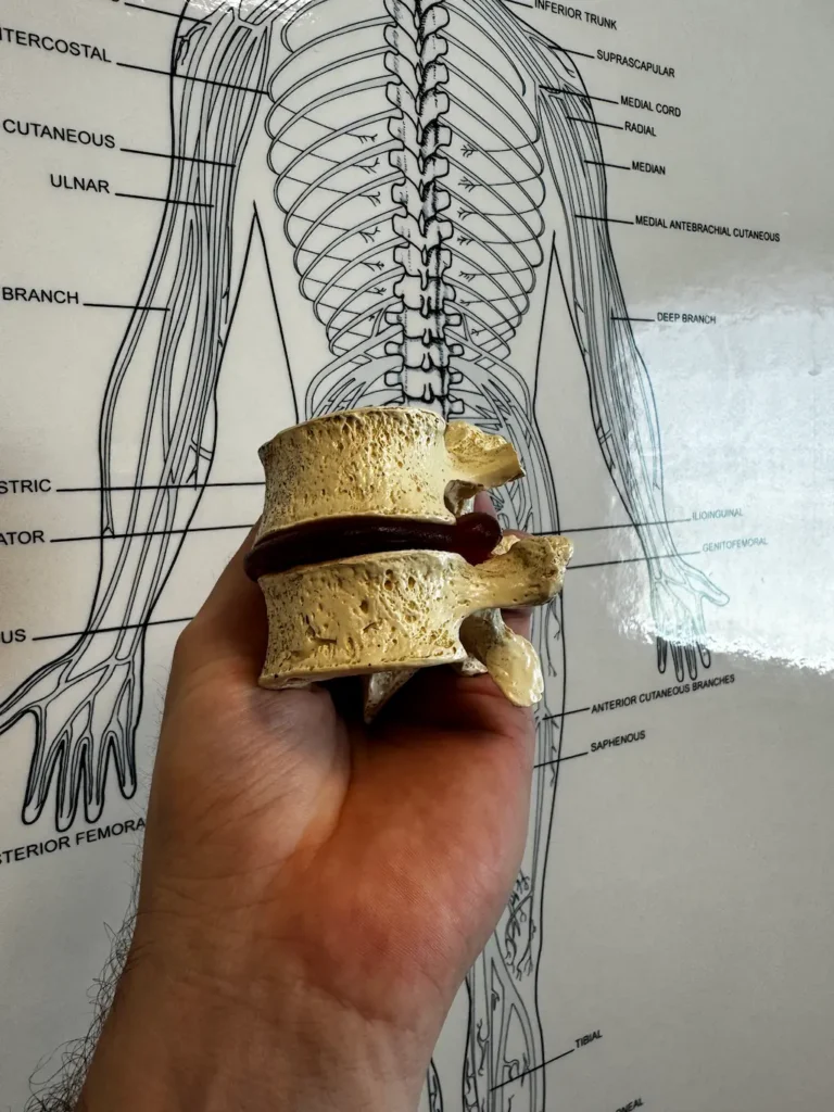 A hand holds a spine model showing a herniated disc, set against a white anatomical chart of the human nervous system.