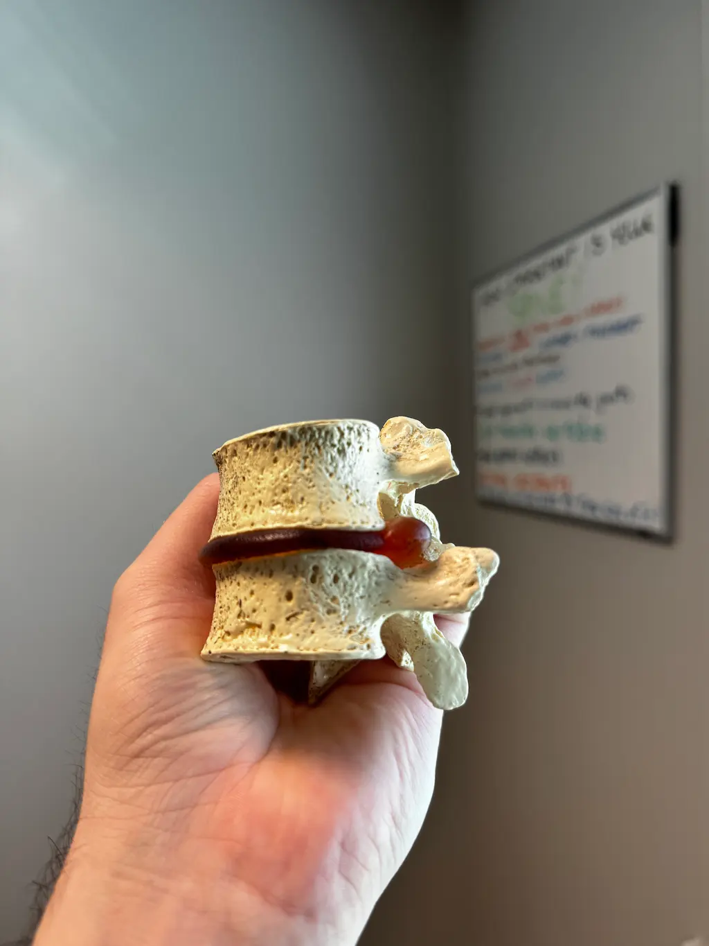 A hand holds a medical model of two bone-colored vertebrae with a dark red herniated disc protruding between them. A blurred whiteboard is in the background.
