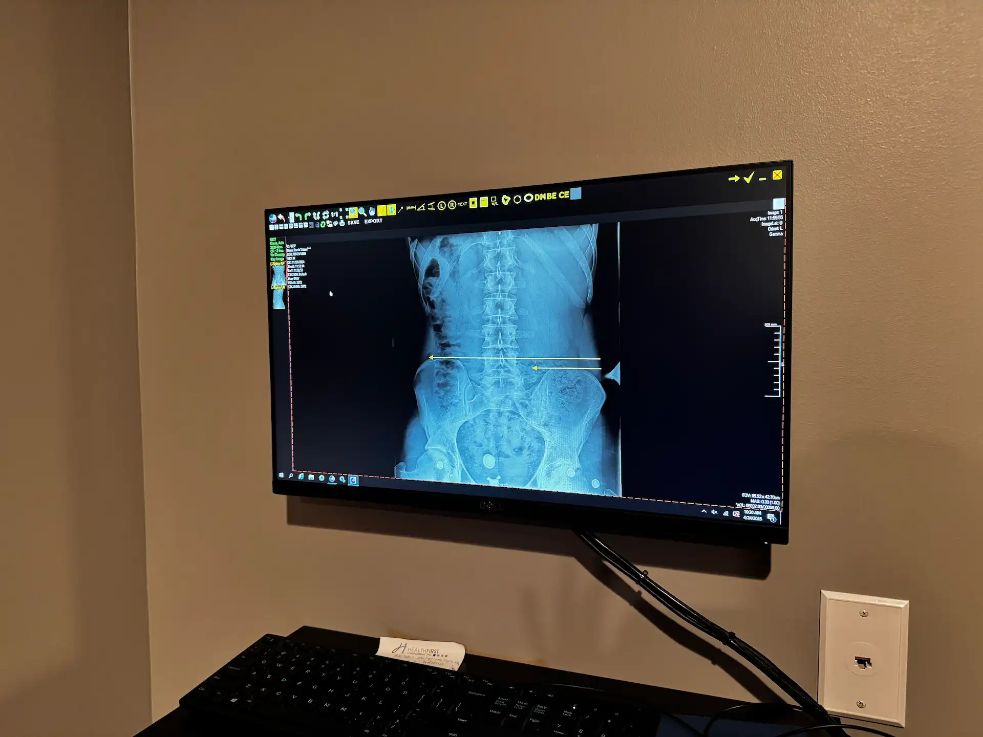 A computer monitor showing a medical X-ray of a human lumbar spine and pelvis with a measurement line. A keyboard and a 'HEALTHFIRST' note are below the monitor.