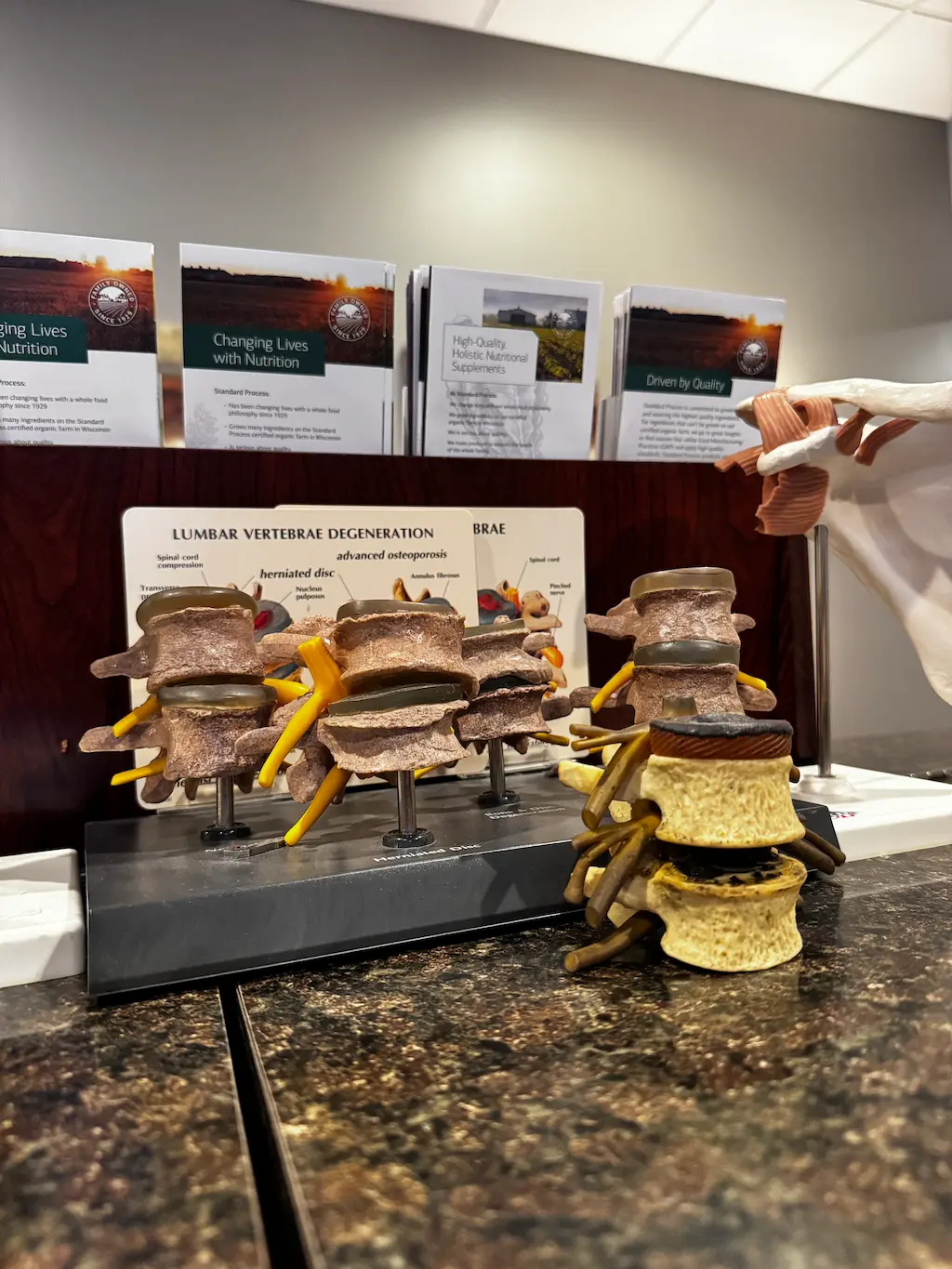 Anatomical models of lumbar vertebrae showing herniated disc and osteoporosis, with informational brochures on nutrition and spinal health in the background.